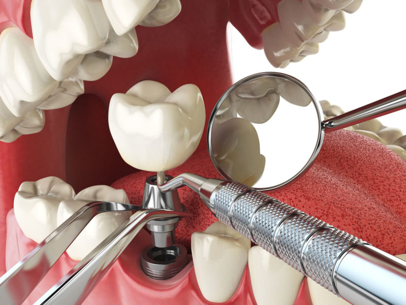 Ottawa Dental Implants